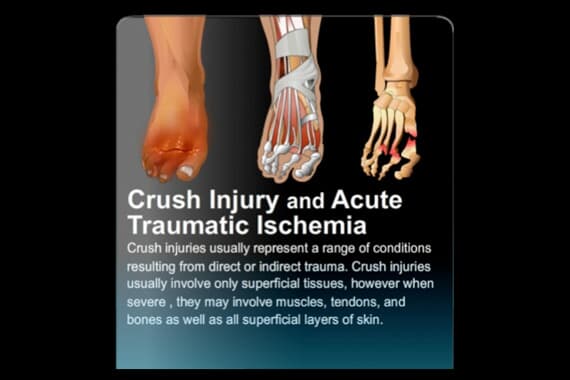 Crush Injury and Acute