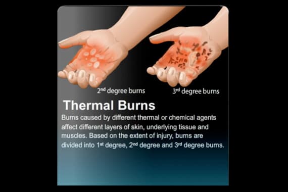 Thermal Burn