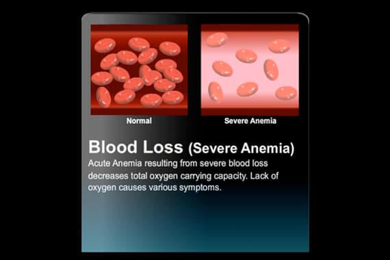 Blood-Loss