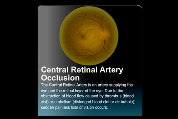 Central Retinal Artery