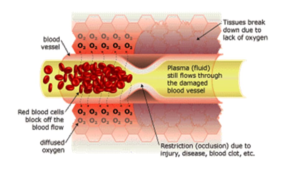 Hyperbaric Oxygenation Effects the Blood Flow 1