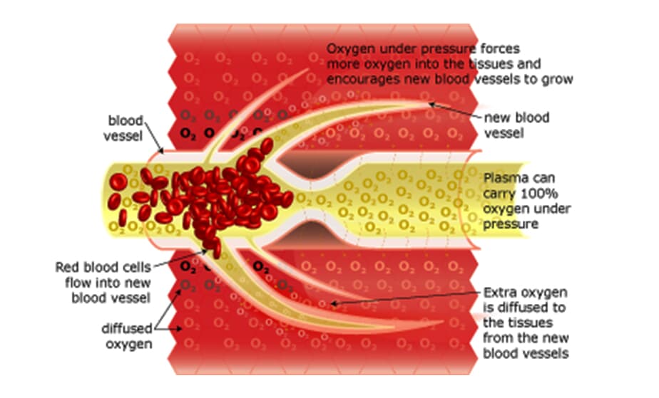 Hyperbaric Oxygenation Effects the Blood Flow 2