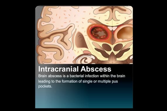Intracranial Abscess