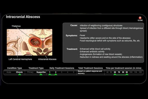 Intracranial Abscess