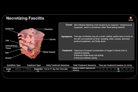 Necrotizing Fasciitis