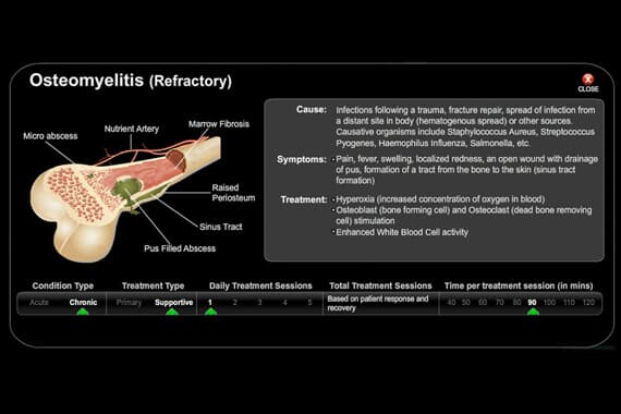 Osteomyelitis Refractory