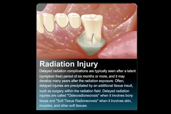 Radiation Injury