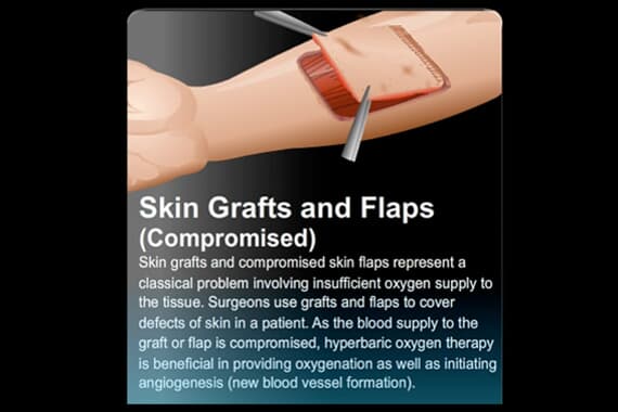 Skin Grafts and Flaps